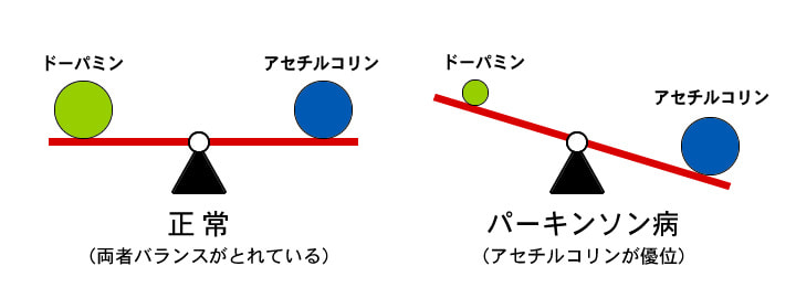 パーキンソン病の説明図