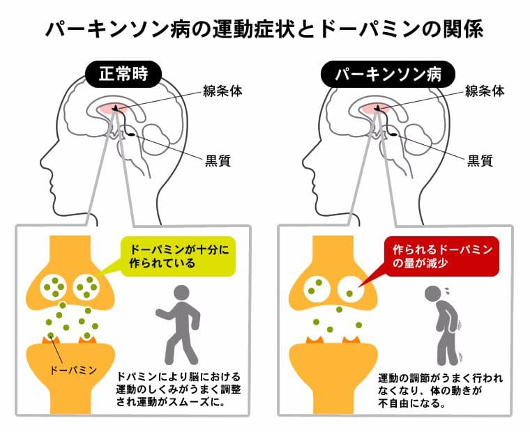 パーキンソン病と正常なドーパミンの図